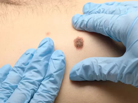 Такие пятнышки сигнализируют о страшном заболевании