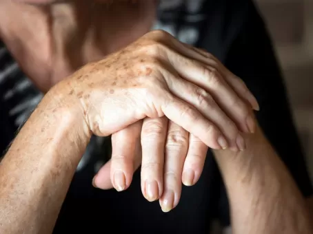 Возрастные пятна: что важно знать и как от них избавиться