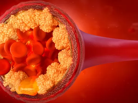 Холестерин уходит даже из капилляров: мощный продукт