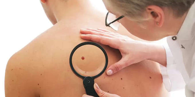 Почему появляются красные родинки