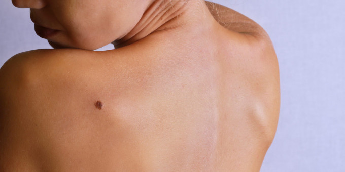 Вот почему подсчет родинок на теле — опасная затея