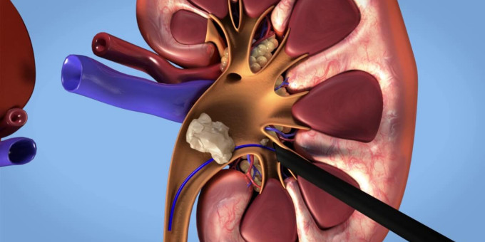 Какой продукт ведет к камням в почках и истончению костей