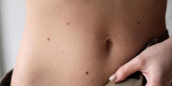Родинки на теле могут много рассказать о вашей личности