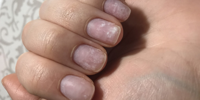 Безошибочные симптомы рака: характерны для любой онкологии