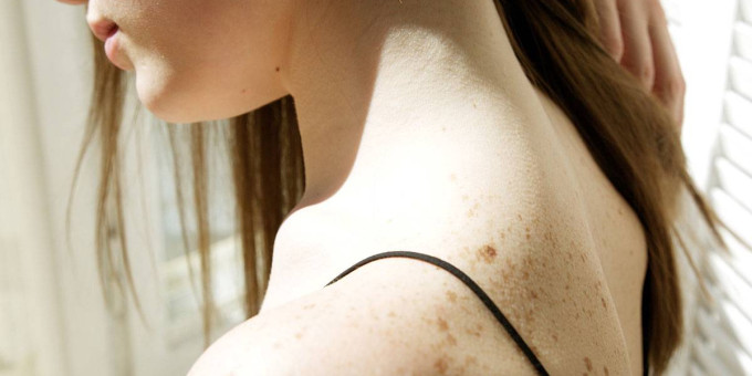 Где на теле человека родинки наиболее опасны