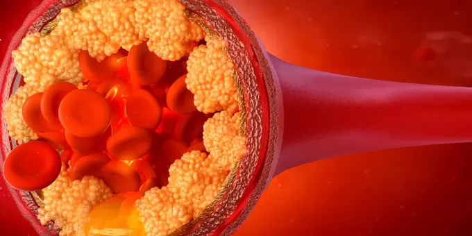 Холестерин уходит даже из капилляров: мощный продукт